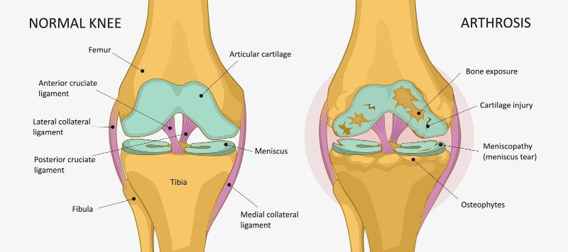 Arthrose im Knie