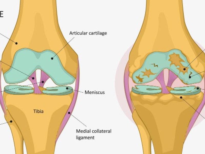 Arthrose im Knie
